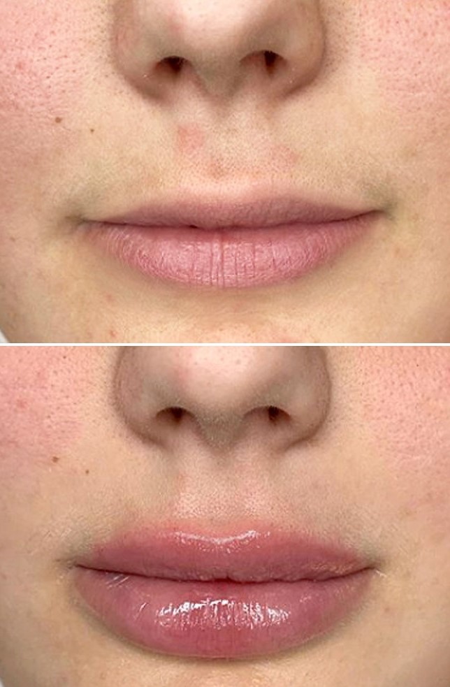 Lips before and after Skinjectpro