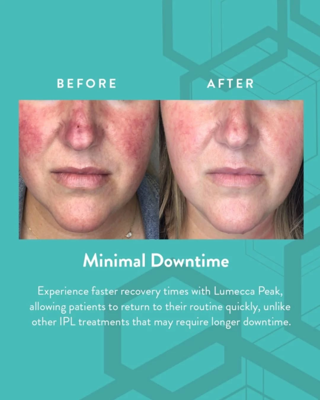 Lumecca Before After 1 e1756444549927