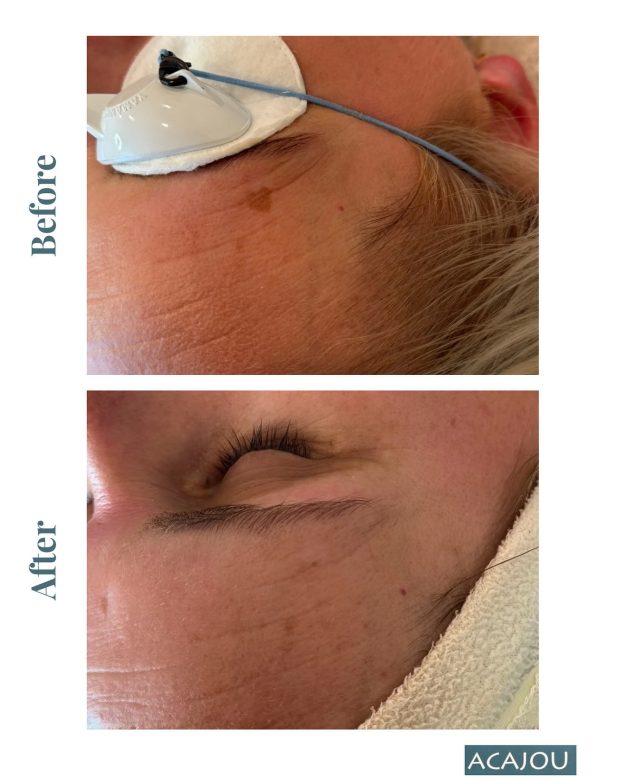 Lumecca Peak Facial Treatment Before and After. At Acajou Spa Ponsonby.