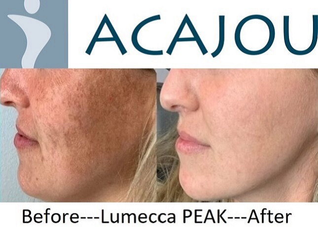 Acajou Before and After Lumecca Peak Treatment