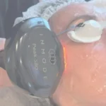Inmode Lumecca Treatment