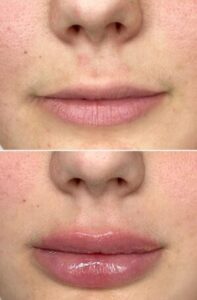 Skinjectpro Before and After